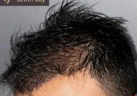 What should I expect after hair transplant?