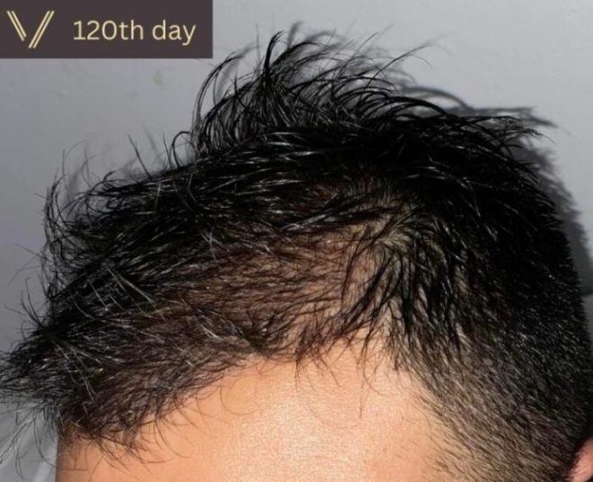 What should I expect after hair transplant?