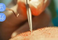 What are the risks of hair transplant surgery?