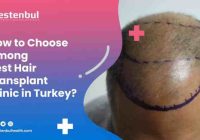 How to choose a hair transplant clinic in Turkey?