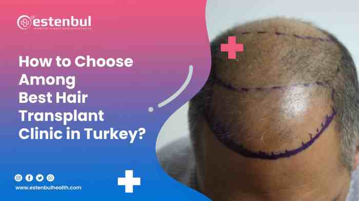 Comparing Hair Transplant Procedures: FUE, DHI, and Robotic Options ... How to choose a hair transplant clinic in Turkey?